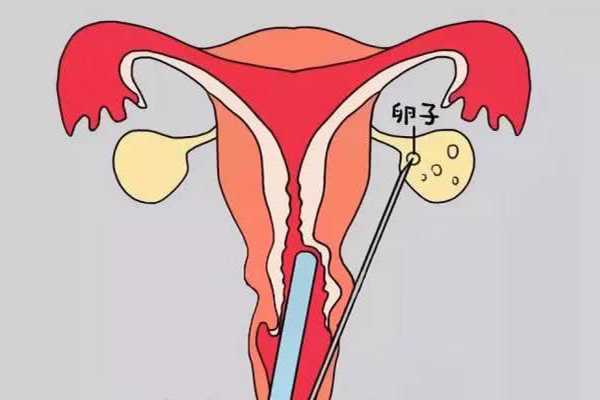 女性卵巢位置高取卵方法解读，要不要经过输卵管看完明白